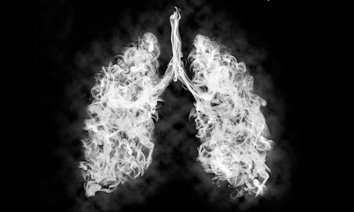 High-Resolution CT der Lunge (HRCT)