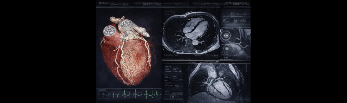 Kardiale Kernspintomographie (Kardio-MRT)